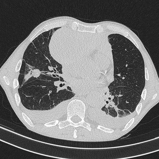 Central venous catheter tip extravasation (Radiopaedia 82828-97113 Axial lung window 50).jpg