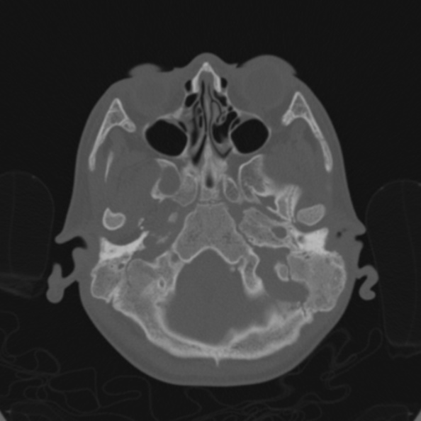 File:Cerebellar abscess secondary to mastoiditis (Radiopaedia 26284-26413 Axial bone window 32).jpg