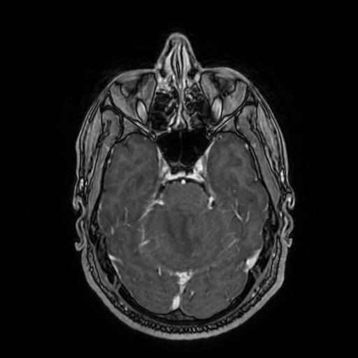 File:Cerebellar hemangioblastoma (Radiopaedia 88055-104622 Axial T1 C+ 67).jpg
