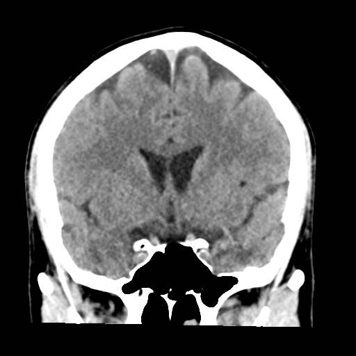 File:Cerebellar hemorrhage (Radiopaedia 37000-38669 Coronal non-contrast 20).png