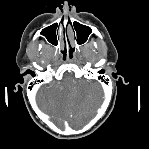 Cerebellar infarct due to vertebral artery dissection with posterior fossa decompression (Radiopaedia 82779-97029 C 24).png