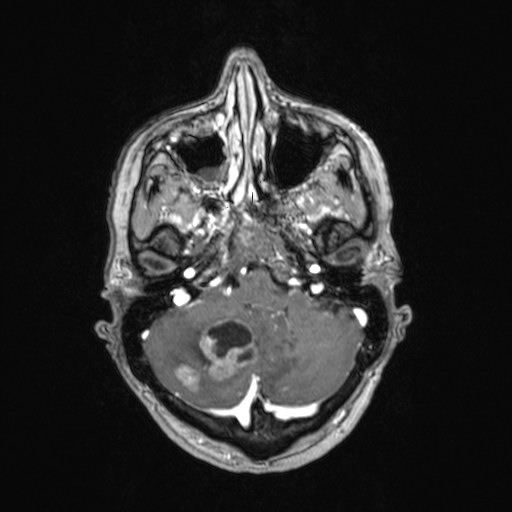 Cerebellar metastases (Radiopaedia 24038-24249 Axial T1 C+ 43).jpg