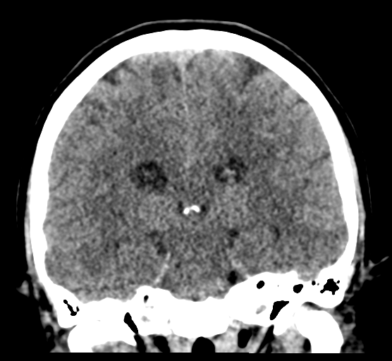 Cerebellar metastases - colorectal adenocarcinoma (Radiopaedia 40947-43652 Coronal non-contrast 56).png