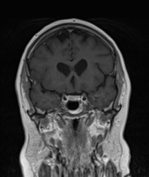 File:Cerebellar metastasis (Radiopaedia 54578-60810 Coronal T1 C+ 14).png
