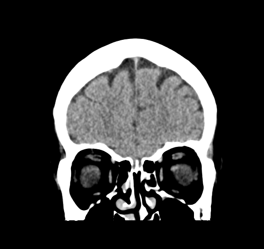 Cerebellar metastasis (Radiopaedia 54578-60812 Coronal non-contrast 10).png