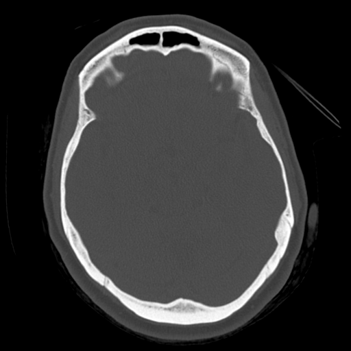 File:Cerebellar metastasis (cystic appearance) (Radiopaedia 41395-44258 Axial bone window 26).png