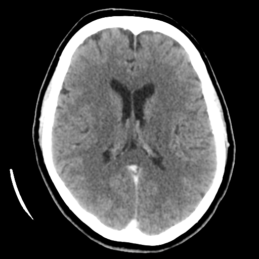 Cerebellar metastasis (cystic appearance) (Radiopaedia 41395-44258 B 29).png