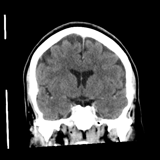 Cerebellar metastasis (cystic appearance) (Radiopaedia 41395-44258 D 28).png