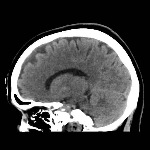 File:Cerebellar metastasis (cystic appearance) (Radiopaedia 41395-44258 E 25).png