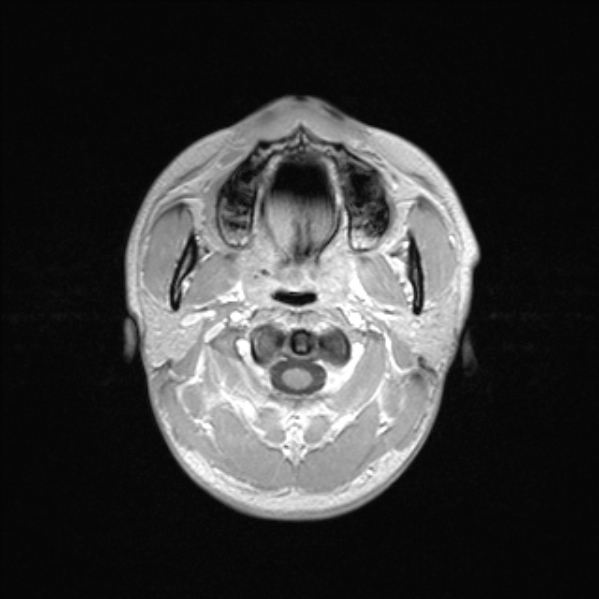 Cerebral abscess (Radiopaedia 24212-24478 Axial T1 C+ 5).jpg
