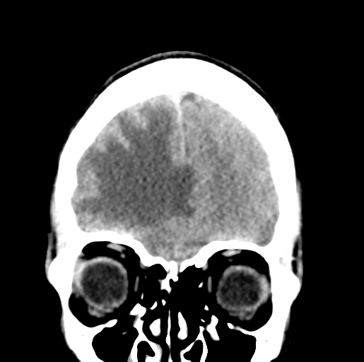 File:Cerebral abscess (Radiopaedia 60342-68008 Coronal non-contrast 12).png