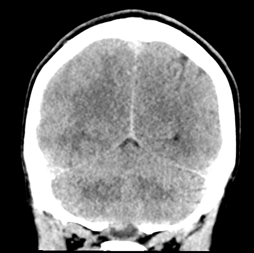 Cerebral abscess (Radiopaedia 60342-68008 Coronal non-contrast 48).png