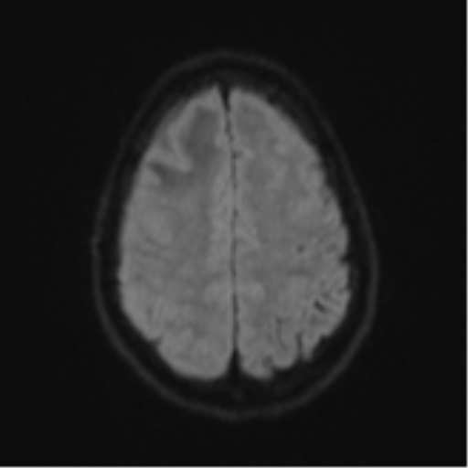 Cerebral abscess (Radiopaedia 60342-68009 Axial DWI 64).png