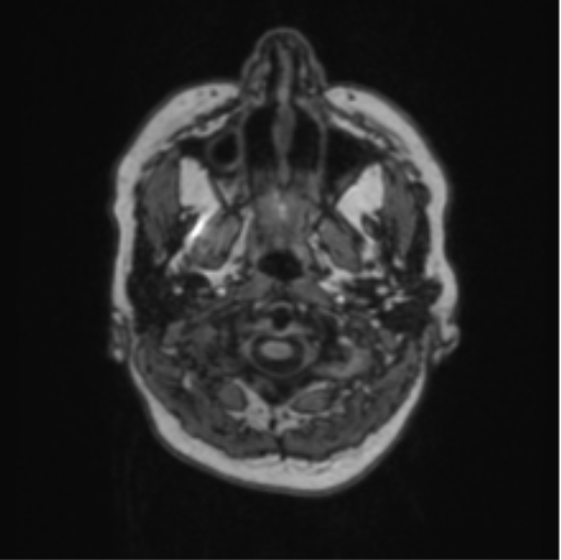 Cerebral abscess from pulmonary arteriovenous malformation (Radiopaedia 86275-102291 Axial T1 3).png