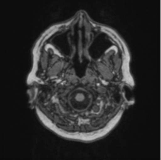 File:Cerebral abscess from pulmonary arteriovenous malformation (Radiopaedia 86275-102291 Axial T1 9).png