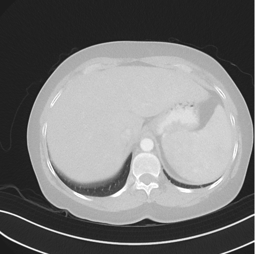 File:Cerebral abscess from pulmonary arteriovenous malformation (Radiopaedia 86275-102292 Axial lung window 53).png
