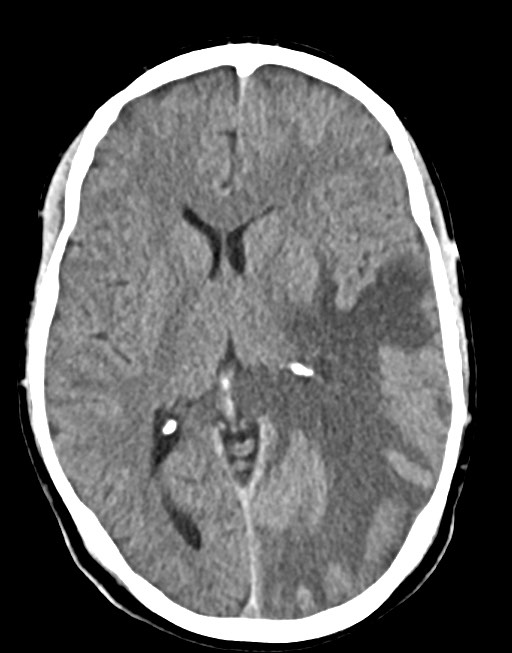 Cerebral abscesses (Radiopaedia 70458-80568 Axial non-contrast 33).jpg