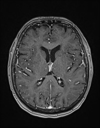 Cerebral amyloid angiopathy-related inflammation (Radiopaedia 58270-65377 Axial T1 C+ fat sat 81).jpg