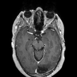 Cerebral amyloid angiopathy (Radiopaedia 29129-29518 Axial T1 C+ 60).jpg