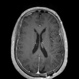 Cerebral amyloid angiopathy (Radiopaedia 29129-29518 Axial T1 C+ 90).jpg