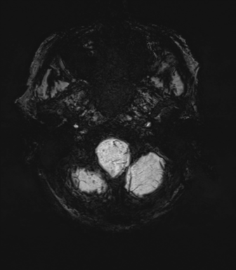 File:Cerebral amyloid angiopathy (Radiopaedia 46082-50433 Axial SWI MIP 6).png