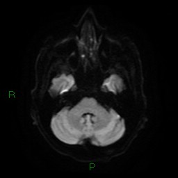 Cerebral amyloid angiopathy (Radiopaedia 77506-89664 Axial DWI 8).jpg