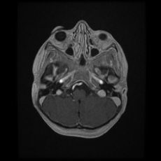 Cerebral and spinal tuberculosis (Radiopaedia 90489-107837 Axial T1 C+ 51).jpg