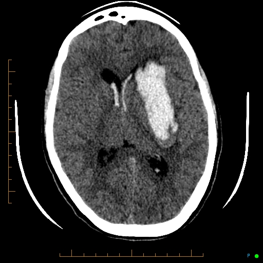Cerebral arteriovenous malformation (AVM) (Radiopaedia 78162-90706 Axial non-contrast 35).jpg