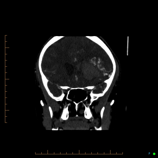 Cerebral arteriovenous malformation (AVM) (Radiopaedia 78162-90706 Coronal CTA 69).jpg