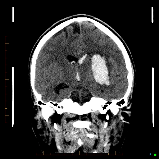 Cerebral arteriovenous malformation (AVM) (Radiopaedia 78162-90706 Coronal non-contrast 51).jpg