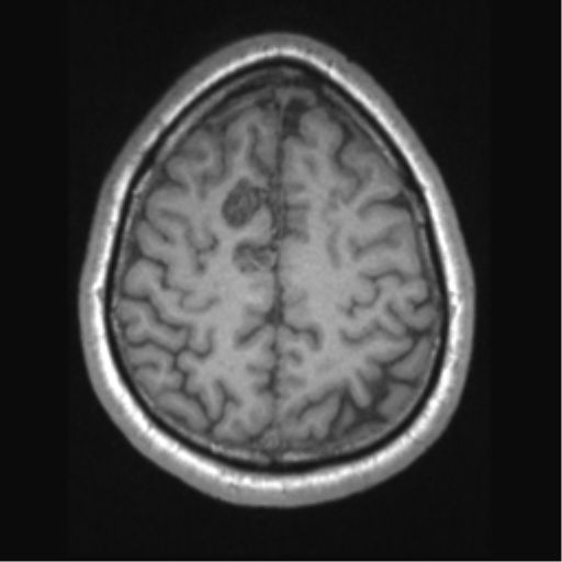 Cerebral arteriovenous malformation (Radiopaedia 39259-41506 Axial T1 60).png