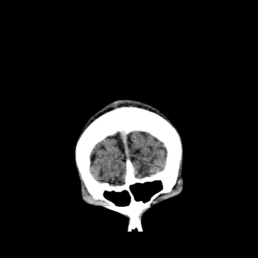 Cerebral arteriovenous malformation (Radiopaedia 61964-70028 Coronal non-contrast 5).jpg