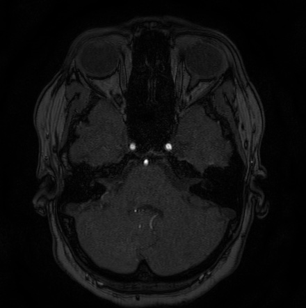 Cerebral arteriovenous malformation (Radiopaedia 74411-85654 Axial MRA 22).jpg