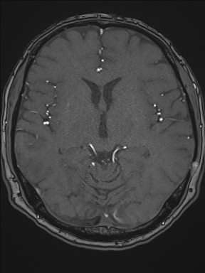 Cerebral arteriovenous malformation (Radiopaedia 84015-99245 Axial TOF 123).jpg