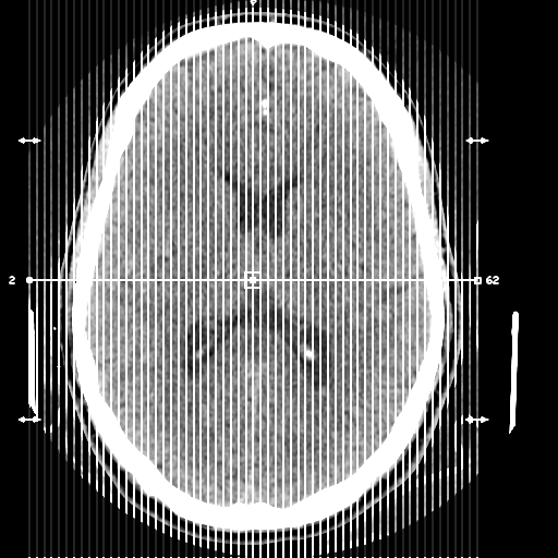 File:Cerebral arteriovenous malformation (Spetzler-Martin grade 2) (Radiopaedia 41262-44076 A 1).png