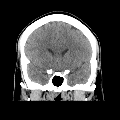 Cerebral arteriovenous malformation (Spetzler-Martin grade 2) (Radiopaedia 41262-44076 Coronal non-contrast 23).png