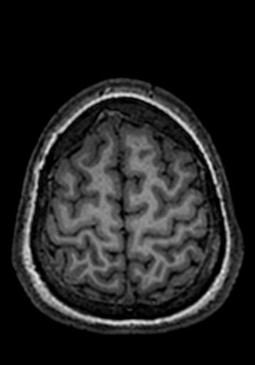 Cerebral arteriovenous malformation at posterior body of corpus callosum (Radiopaedia 74111-84925 Axial T1 33).jpg