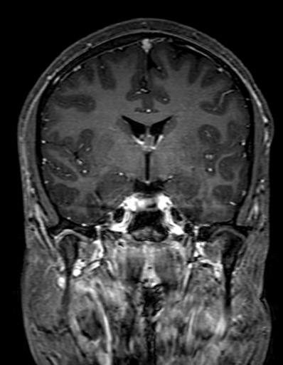 Cerebral arteriovenous malformation at posterior body of corpus callosum (Radiopaedia 74111-84925 K 163).jpg