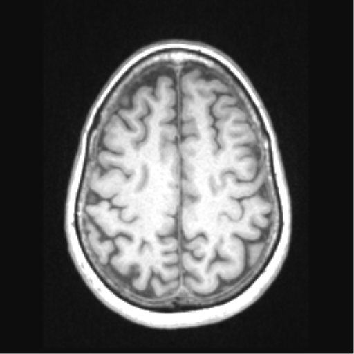 Cerebral arteriovenous malformation with hemorrhage (Radiopaedia 34422-35737 Axial T1 58).png