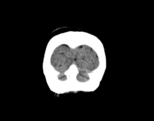 File:Cerebral arteriovenous malformation with lobar hemorrhage (Radiopaedia 44725-48510 Coronal non-contrast 44).png