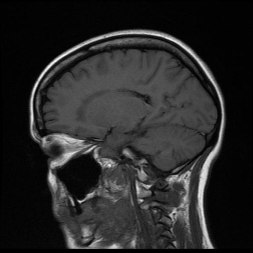 File:Cerebral autosomal dominant arteriopathy with subcortical infarcts and leukoencephalopathy (CADASIL) (Radiopaedia 41018-43768 Sagittal T1 8).png