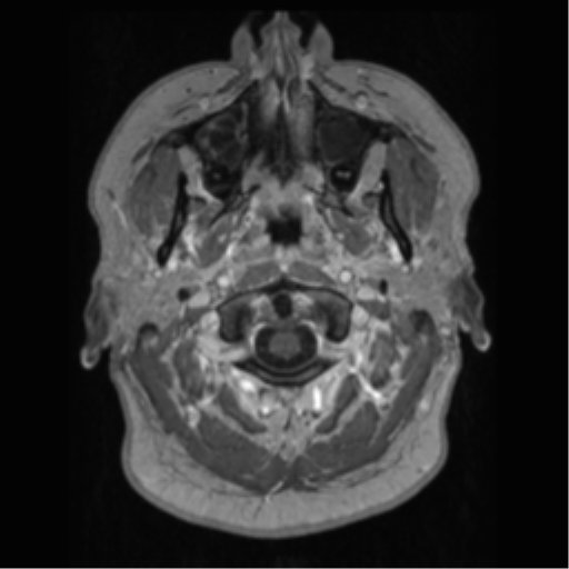 Cerebral cavernoma and development venous anomaly (Radiopaedia 37603-39482 Axial T1 C+ 4).png