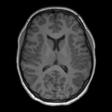 Cerebral cavernous venous malformation (Radiopaedia 70008-80021 Axial T1 43).jpg