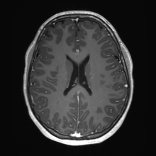 Cerebral cavernous venous malformation (Radiopaedia 70008-80021 Axial T1 C+ 50).jpg