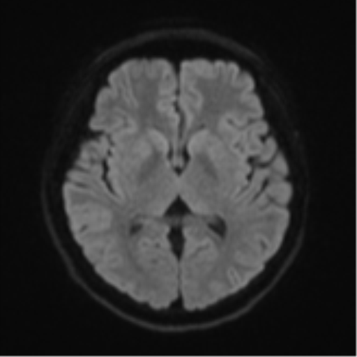 Cerebral cavernous venous malformations (Radiopaedia 48117-52946 Axial DWI 42).png