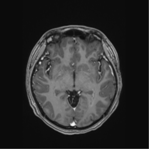 Cerebral cavernous venous malformations (Radiopaedia 48117-52946 Axial T1 C+ 26).png