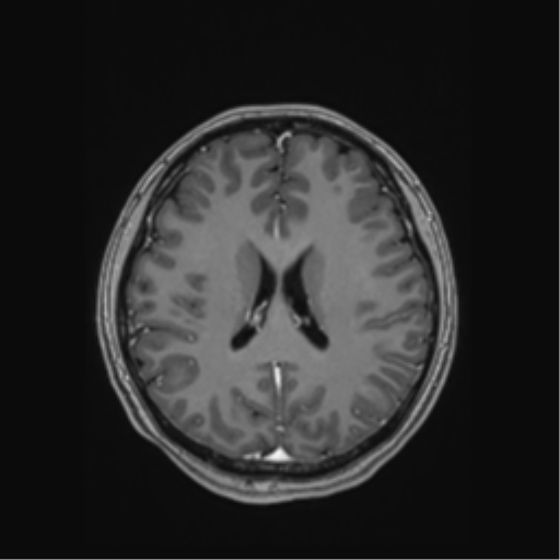 Cerebral cavernous venous malformations (Radiopaedia 48117-52946 Axial T1 C+ 38).png