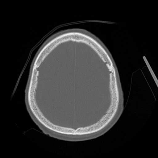 File:Cerebral contusions, subarachnoid hemorrhage and subdural hygromas (Radiopaedia 55399-61827 Axial bone window 42).png