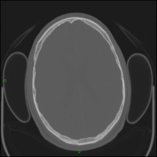 Cerebral contusions (Radiopaedia 33868-35039 Axial bone window 133).jpg