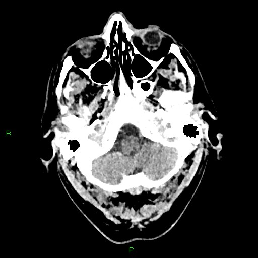File:Cerebral contusions (Radiopaedia 33868-35039 Axial non-contrast 24).jpg